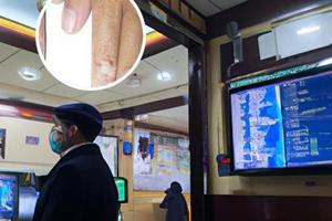 伍德灯下有荧光,但是医生说不像